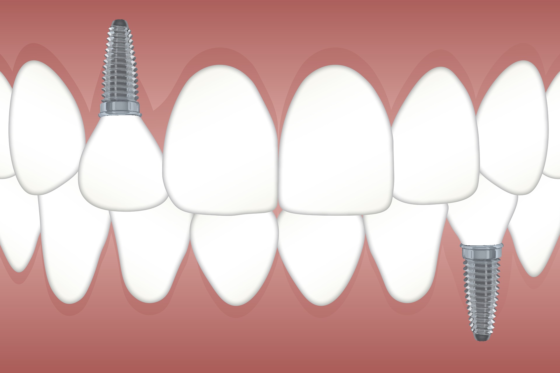 имплантация зуба цена